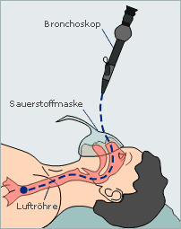 Bronchoskop